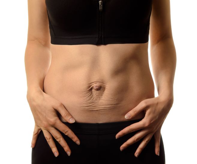 diastasis recti woman's stomach